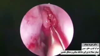 عمل جراحی شاخک های بینی