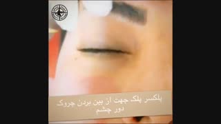 پلکسرپلک جهت از بین بردن چروک دور چشم