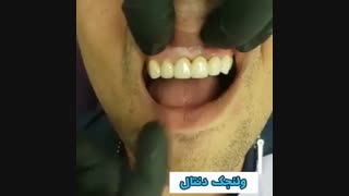 رفع نامرتبی دندانها, دندان های مرتب و یکدست