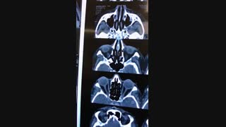 جراحی اربیت