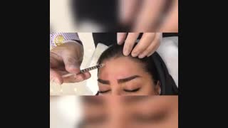 فیلم تزریق بوتاکس