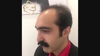 کاشت مو رنسانس - کلینیک تخصصی رنسانس کشیدن دندان