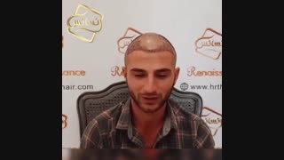 کاشت مو رنسانس - کلینیک تخصصی رنسانس آر اف فرکشنال