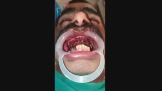 جراحی فول ایمپلنت فک بالا توسط دکتر شهریار جنانی