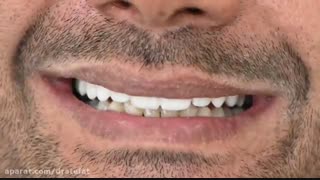 لمینیت سرامیکی دندان های فک بالا