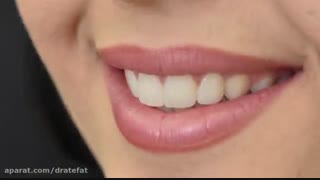 ونیر کامپوزیت طبیعی برای  4 دندان بالا