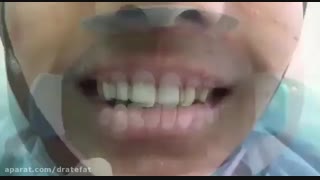 تعویض ونیر کامپوزیت