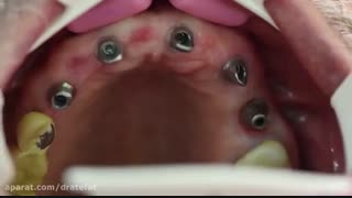 ایمپلنت دندان های فک بالا