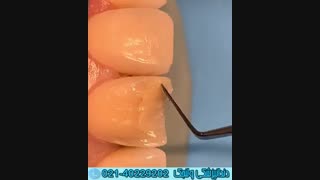 دندانپزشکی زیبایی و ترمیم همرنگ دندان ردیف جلو