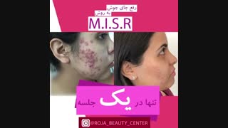 رفع جای جوش