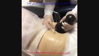 کویتیشن و لاغری موضعی سریع
