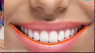 اصلاح طرح لبخند چیست ؟