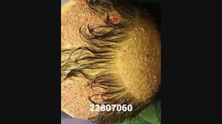 کاشت مو - 22807060