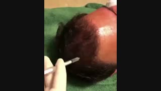 مزوتراپی - 22807060