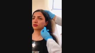 لیفت صورت با تزریق ژل