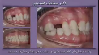 ارتودنسی با کلیر الاینر | دکتر همت پور