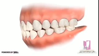 الاستیکهای ارتودنسی | دکتر همت پور