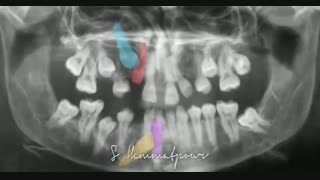 تصحیح موقعیت دندانها در یک بیمار کلیدوکرانیال | دکتر همت پور