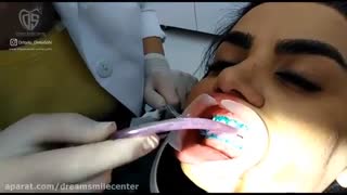 سفید کردن و بلیچینگ دندان با لیزرتراپی تزریق ژل