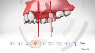 ایمپلنت دندان