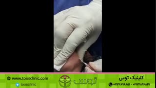 تخلیه ژل پاژ که قبلا در کلینیک دیگری تزریق شده