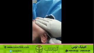 میکرو لیپوی صورت، جهت تخلیه چربی صورت. فرم دهی و زاویه دهی به صورت