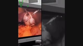 جراحى لاپاراسکوپى کیسه صفرا