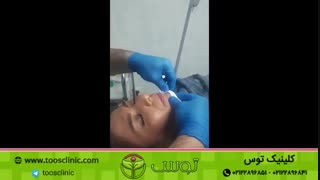 تزریق فیلر چانه