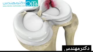 درمان پارگی مینیسک زانو بدون عمل جراحی