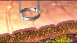 اجاره لیزر الکساندرایت کلاریتی