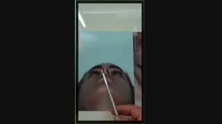 جراحی بینی ترمیمی