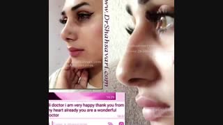 نمونه کار جراحی بینی