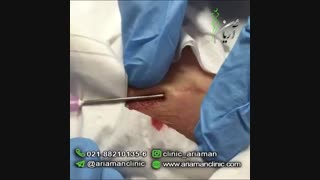 سابسیژن پوست در کلینیک زیبایی آریامن | 41608-021