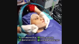 فیلم میکرودرم در کلینیک زیبایی آریامن