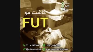 فیلم کاشت مو به روش FUT | کلینیک کاشت مو آریامن زیبایی پوست