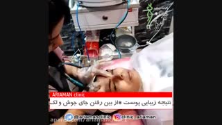 فیلم انجام میکرودرم و هیدرودرم در کلینک زیبایی آریامن 02188210135