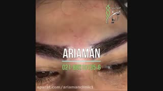 کاشت و عمل پیوند ابرو در کلینیک زیبایی آریامن 02142485000