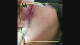 رفع چین و چروک اطراف لب با پلکسر