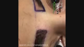 فیلم کاشت ابرو در کلینیک زیبایی آریامن 02142485000