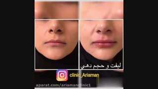 فیلم تزریق ژل در لب | کلینیک زیبایی آریامن 02142485000
