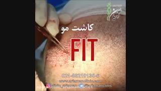 فیلم کاشت مو به روش FIT | کلینیک زیبای آریامن 02142485000 منافذ باز پوست