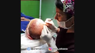 فیلم عمل کاشت مو | کلینیک کاشت مو و زیبایی آریامن 02142485000