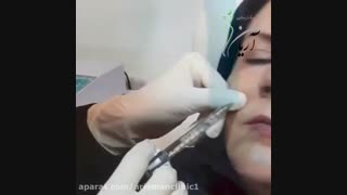 فیلم مراحل تزریق ژل و بوتاکس | تزریق ژل لب | کلینیک آریامن 02141608 بررسی لک صورت