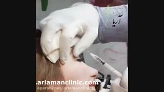 تزریق ژل و بوتاکس در لب و چشم | کلینیک زیبایی آریامن 02188210135 پروتز دندان