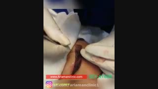 فیلم مراحل کاشت ابرو در کلینیک آریامن 02142485000