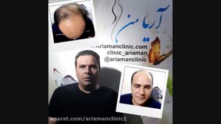 رضایت از عمل کاشت مو در کلینیک کاشت مو و زیبایی آریامن  02141608