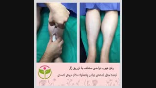 رفع عیوب نواحی مختلف بدن با تزریق ژل
