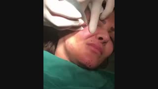 برداشت خال - 02122807060
