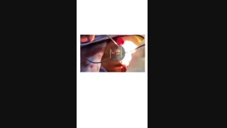 فلج عصب صورت در اثر نزاع