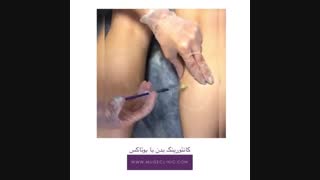 کانتورینگ بدن با بوتاکس